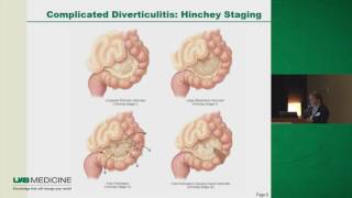 DIVERTICULAR DISEASE How To DIAGNOSE amp TREAT Lower GI Hemorrhage Acute LLQ Pain [upl. by Aron]