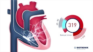 How to use the HeartSine Samaritan 500P defibrillator [upl. by Aiceled]