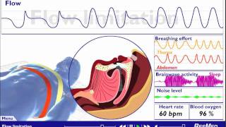 Understanding Sleep Disordered Breathing [upl. by Adnana]