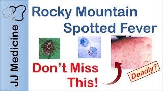 Rocky Mountain Spotted Fever  Bacteria Signs amp Symptoms Diagnosis and Treatment [upl. by Maurizia]