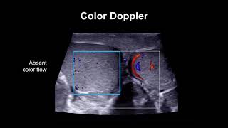 Diagnosing testicular torsion [upl. by Walling]