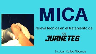 JUANETES TÉCNICA MICA Nueva cirugía para el tratamiento de los Juanetes ¿En qué consiste [upl. by Ueih]