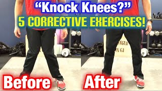 quotKnock Kneesquot Genu Valgum 5 BEST CORRECTIVE EXERCISES  Dr Wil amp Dr K [upl. by Nuli]