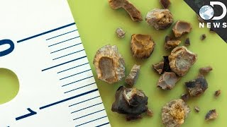 Everything You Need To Know About Kidney Stones [upl. by Assetan]