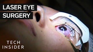 What Its Like To Get Laser Eye Surgery [upl. by Martelli584]