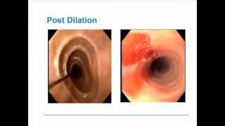 Eosinophilic Esophagitis [upl. by Jermain]