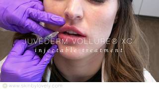 Juvederm Vollure  Lip Enhancement Demo  Skin by Lovely [upl. by Hcib]