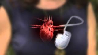 Pacemakers and Defibrillators What’s New [upl. by Lorrayne630]