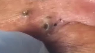 LARGE Blackheads Removal  Satisfying Blackhead 2019 Part 04 [upl. by Yttap]