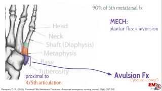 5th Metatarsal Fractures [upl. by Floria]