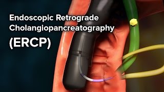 Percutaneous antegrade jj stent insertion [upl. by Macrae]