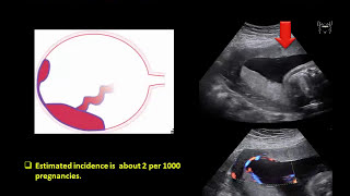 Ultrasound Imaging of the placenta Part 1 Anatomy and Variants [upl. by Itaws]