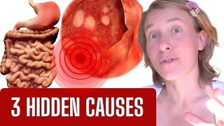 What Causes Gastritis [upl. by Raina]