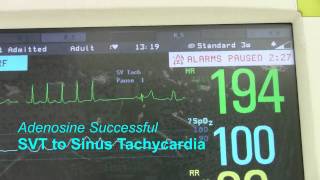 SVT or Supraventricular Tachycardia [upl. by Sheff]