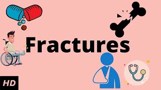 Hop test  Clinical Examination Stress Fractures [upl. by Maier]