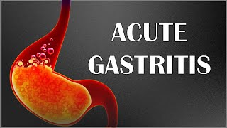 What causes erosive gastritis  Health Channel Best Answers [upl. by Mario951]