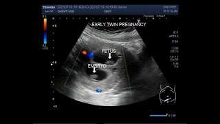 Early first trimester twin Pregnancy  08 weeks [upl. by Adnimra337]