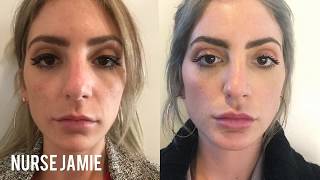 Before and After Micro Needling  Nurse Jamie [upl. by Sad173]