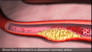 Angina and coronary heart disease [upl. by Aerdnu]