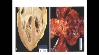 Pathology Second  Dr Nafea  Thrombosis 2 [upl. by Latsirc395]