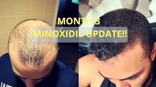 Month 3 ROGAINE RESULTS Minoxidil  Regrowth [upl. by Nehemiah126]