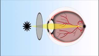 Presbyopia Explained Annimated Video [upl. by Attezi]