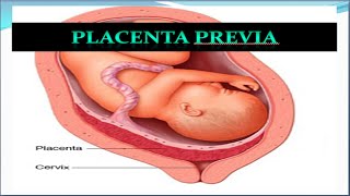 Placenta Previa Update [upl. by Daniele518]