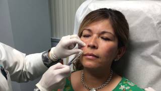 Juvederm Vollure Injection Treatment [upl. by Mouldon]