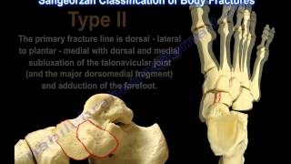 Lisfranc Injury  Everything You Need To Know  Dr Nabil Ebraheim [upl. by Muire]