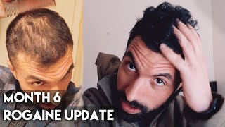 6 Month Rogaine Results Minoxidil [upl. by Aikaj788]