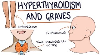 Understanding Hyperthyroidism and Graves Disease [upl. by Eelyk475]