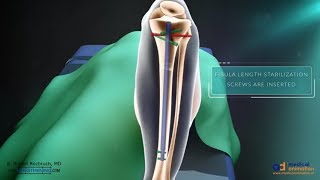 Tibia Interlocking Nail Complete Procedure [upl. by Ellingston]