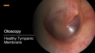 Tympanic Membrane Otosopy [upl. by Llertnac]