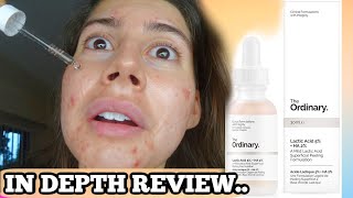 I TESTED THE ORDINARY LACTIC ACID FOR MY ACNE SCARS FOR 3 WEEKS THIS IS WHAT HAPPENED [upl. by Ivar]