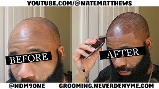 How To Get Your Hairline Back  From Bald To Edge Up  Hairline Restoration [upl. by Imer]