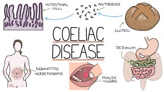 Understanding Coeliac Disease [upl. by Ahsaf181]