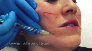 Volite InjectionsSkinboosters [upl. by Yeniffit622]