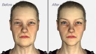 Facelift amp Neck Lift surgery  Dr Julian De Silva  3D medical animation [upl. by Agate]