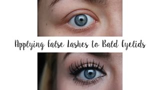 Applying False Lashes to Bald Eyelids Trichotillomania  G Beauty [upl. by Madlin]