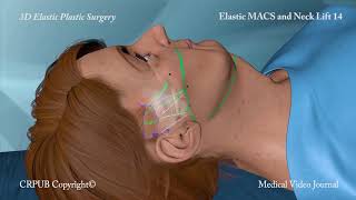 3D MACS and Neck Lift [upl. by Winer]