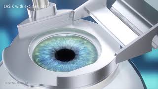 LASIK Procedure Animation [upl. by Ahsote]