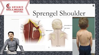 Sprengel Shoulder [upl. by Lauhsoj]