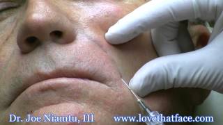 Nasolabial Fold Filler with Cannula by Dr Joe Niamtu [upl. by Eirod]