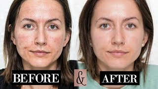 My MICRONEEDLING Experience  Skin Updates  Before amp After [upl. by Seif50]