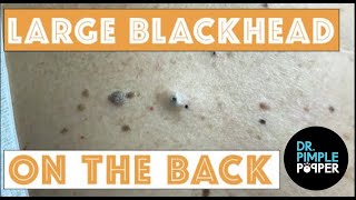 Large Blackheads on the Back [upl. by Volny]