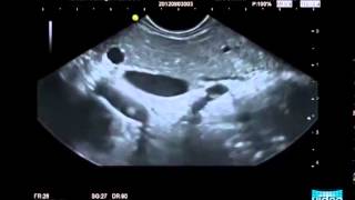 Endosonography in Autoimmune Pancreatitis [upl. by Hugues66]