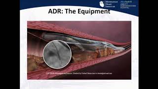 Antegrade DissectionReentry StepbyStep  M Nicholas Burke MD [upl. by Serene]