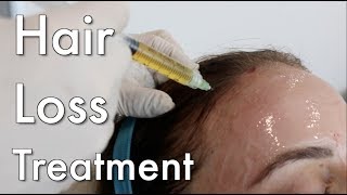 Hair Loss Treatment PRP [upl. by Enilec]