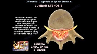 lumbar Stenosis  Everything You Need To Know  Dr Nabil Ebraheim [upl. by Enitnemelc]