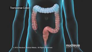 Colon Problems Diverticular Disease [upl. by Menashem]